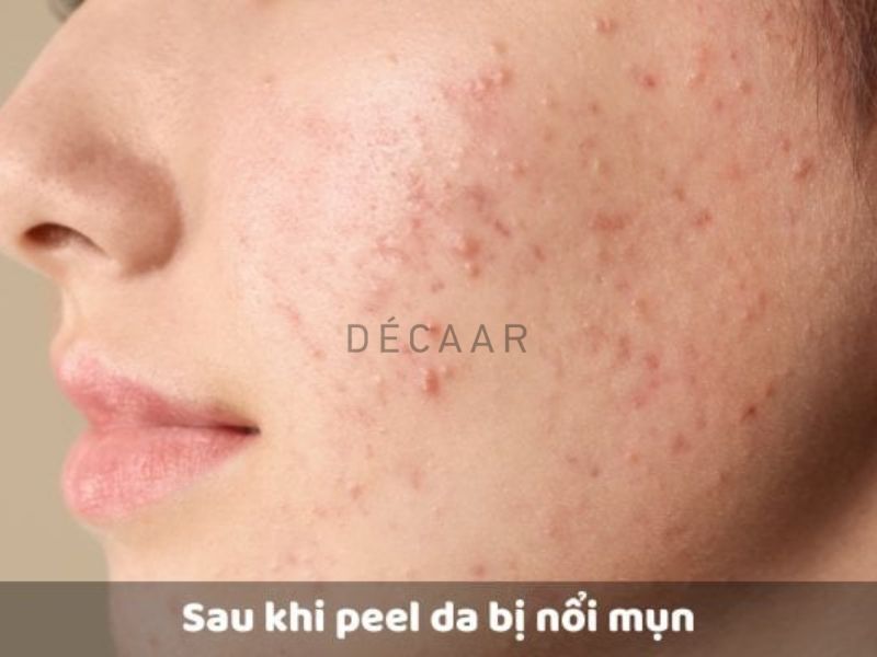 Rủi ro có thể gặp sau peel